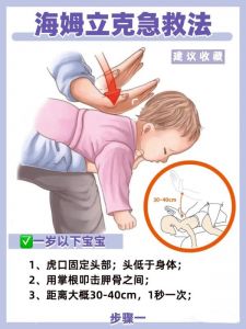 海姆立克法 海姆立克法