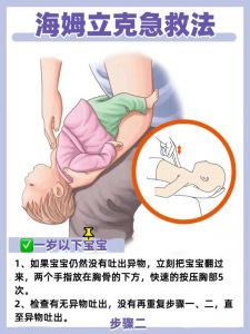 海姆立克法 海姆立克法