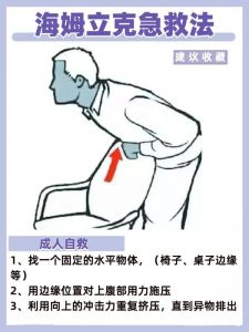 海姆立克法 海姆立克法