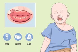 單純皰疹 單純皰疹